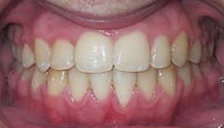 After Invisalign treatment