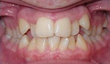 Before Invisalign treatment