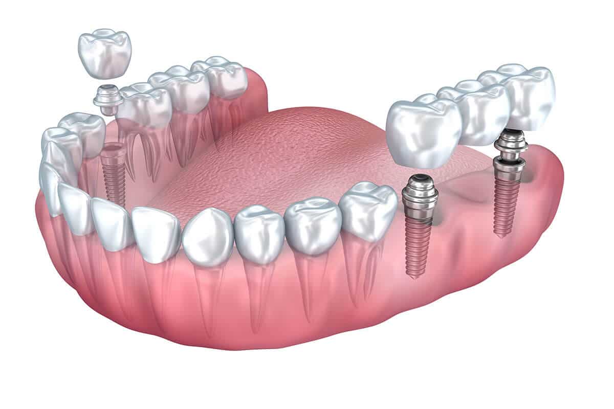 Implantes vs Puentes: ¿Cuál es la Mejor Opción?
