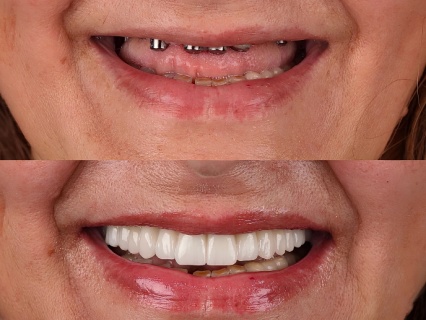 Success Case 2 - Reconstrucción Estética Anterior