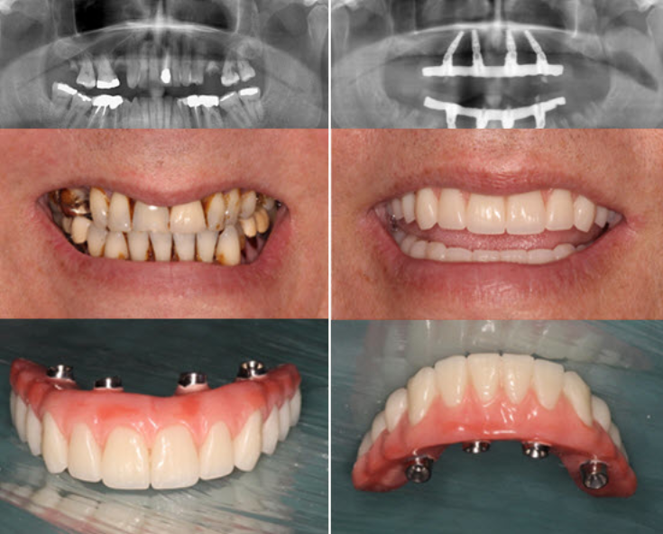 Success Case 1 - Reconstrucción Completa All-on-4