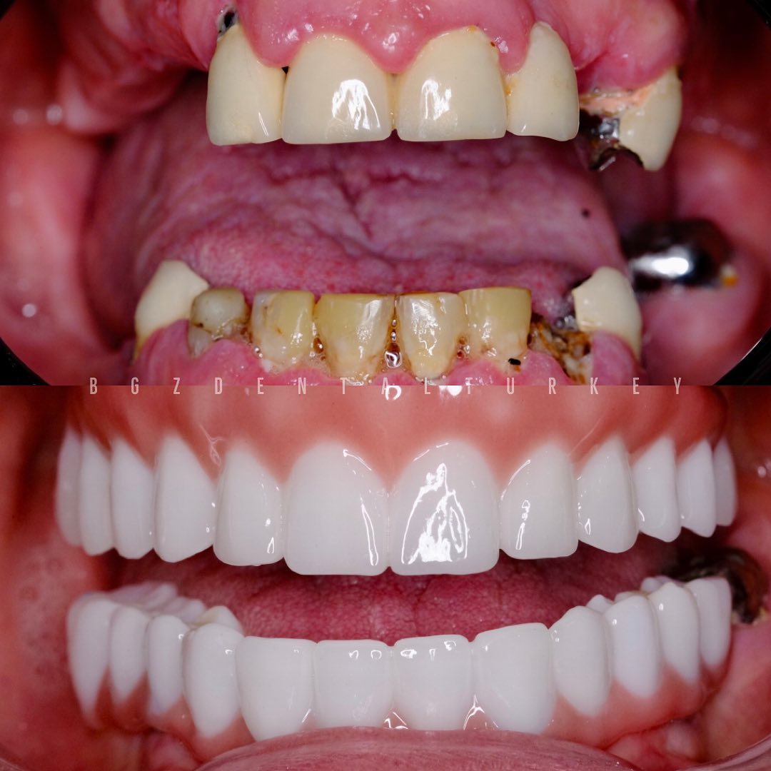 Success Case 4 - Caso de Periodontitis Avanzada