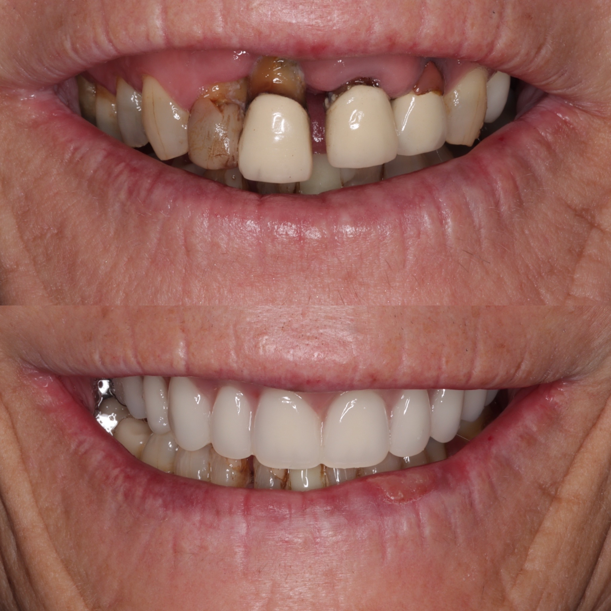 Success Case 5 - Restauración de Dentición Mixta