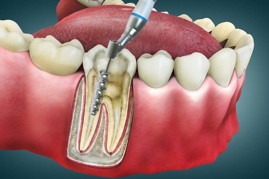 3D illustration of endodontic root canal procedure showing dental instrument cleaning infected tooth pulp