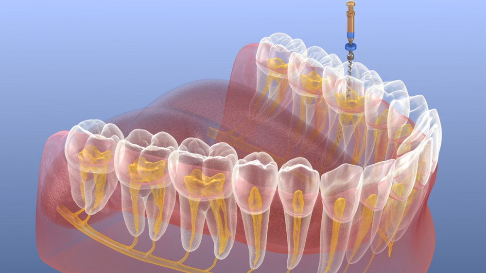 3D anatomical illustration showing tooth root canals and endodontic treatment procedure