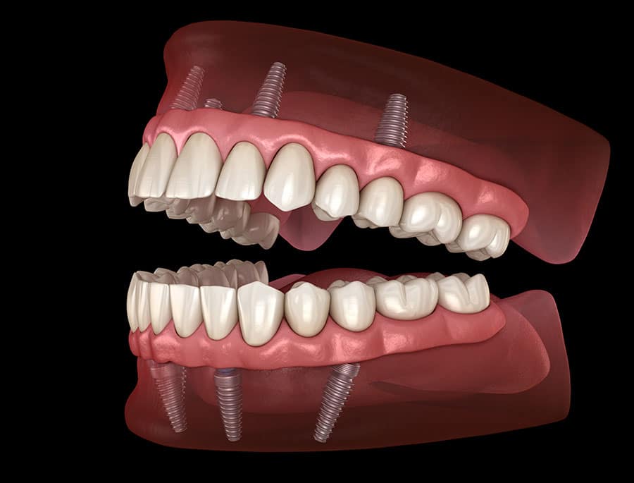Ilustración 3D del sistema de implantes dentales All-on-4 mostrando implantes de titanio soportando prótesis de arco completo