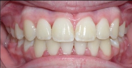 After braces treatment