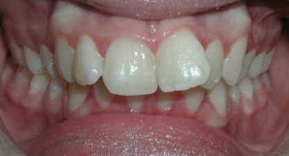 Before braces treatment
